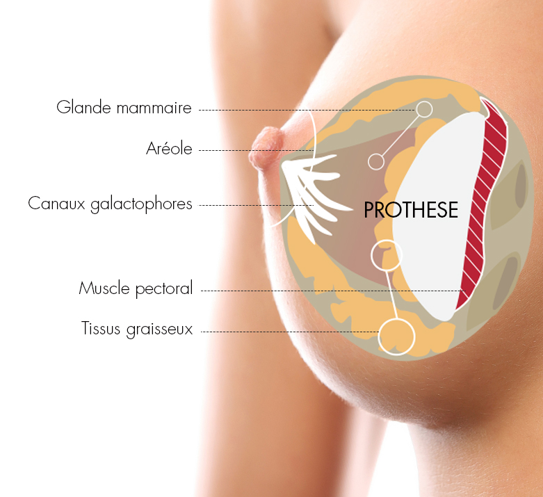 chirurgie esthétique du sein augmentation mammaire par prothèse mammaire
