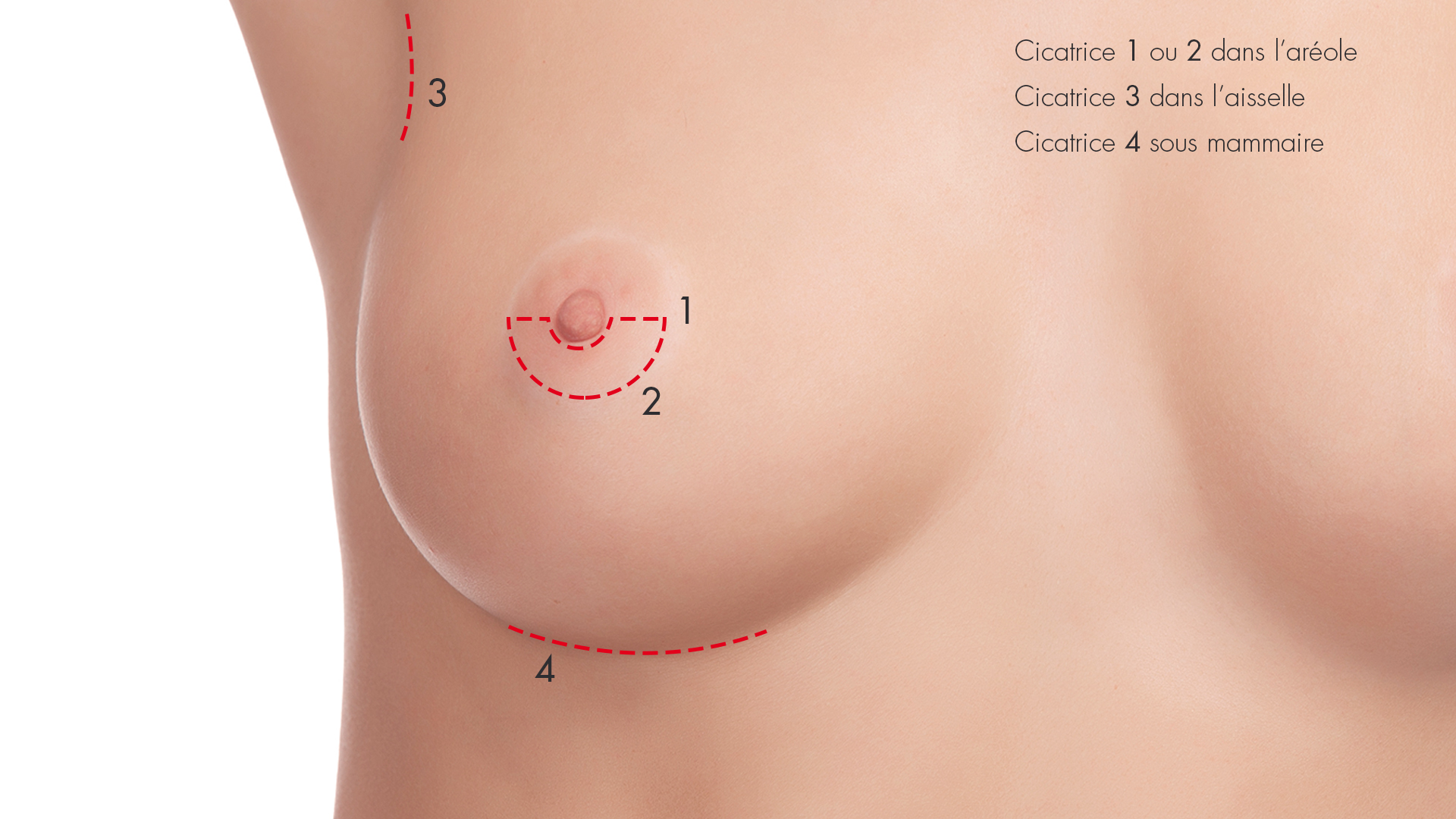 chirurgie esthétique du sein augmentation mammaire