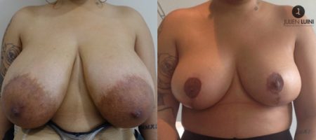 reduction-mammaire-nice-resultat-chirurgie-esthetique-nice-2