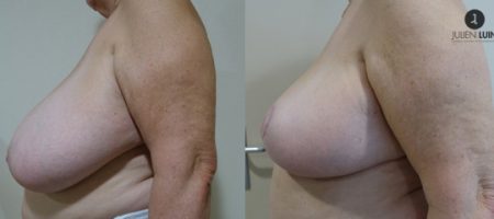 reduction-mammaire-nice-resultat-chirurgie-esthetique-nice
