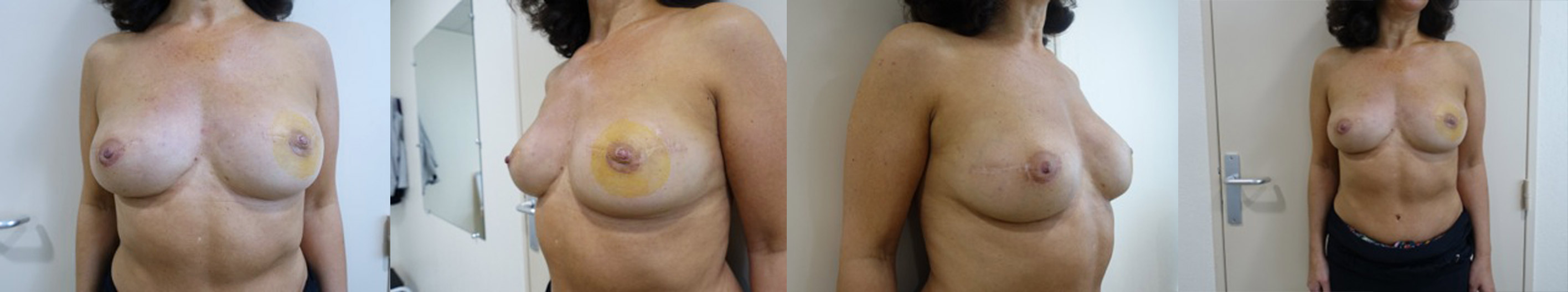 docteur-luini-patiente-1-reconstruction-mammaire