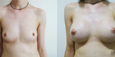 patient001-augmentation-mammaire