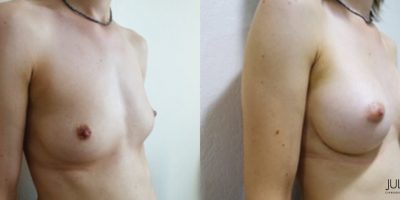 patient001-augmentation-mammaire-v2