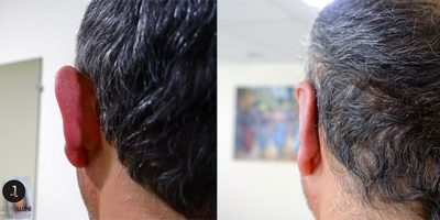 Docteur Luini – avant après derrière oreille