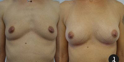 Augmentation mammaire par Lipofilling