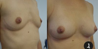 Augmentation mammaire par lipofiling