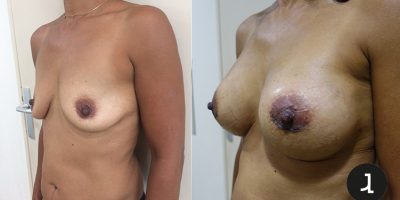 Augmentation mammaire Docteur Julien Luini chirurgien esthétique