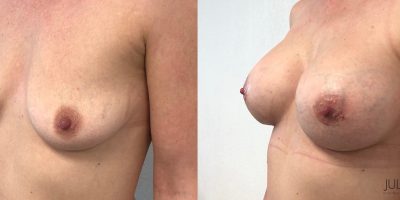 Augmentation mammaire par prothèses, avant / après