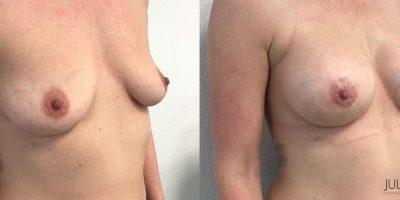 Augmentation mammaire par prothèses, avant / après