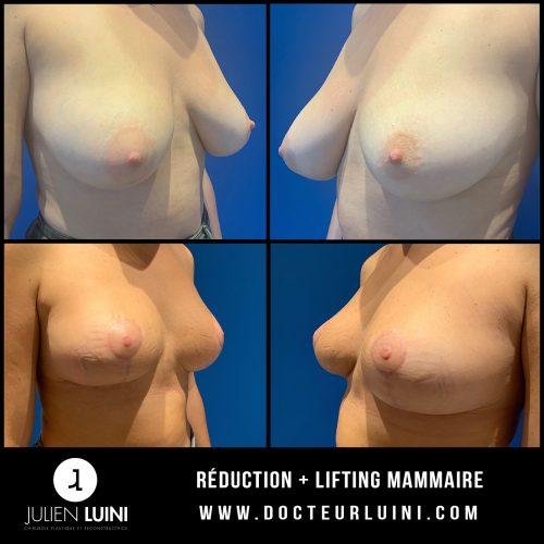 Réduction – Lifting mammaire