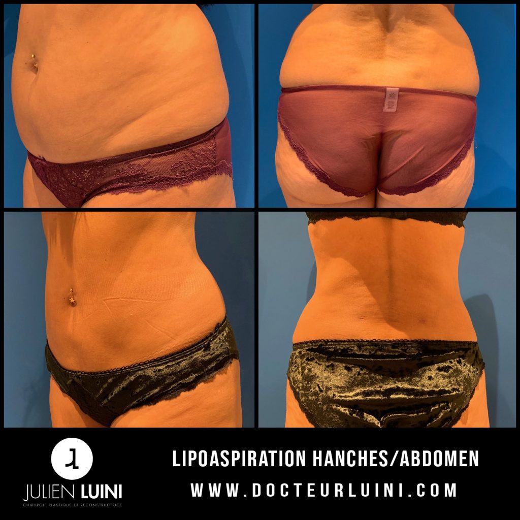 Lipoaspiration