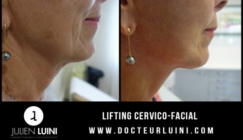 Lifting cervico-facial