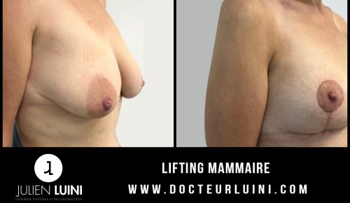 Lifting mammaire