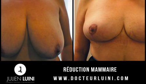 Réduction mammaire
