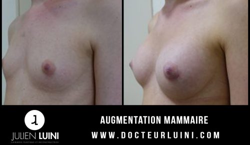 Augmentation mammaire