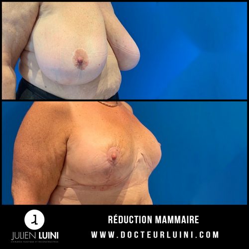 chirurgie esthétique du sein la réduction mammaire