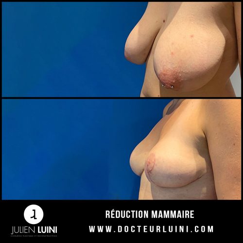 Chirurgie esthétique du sein : réduction mammaire